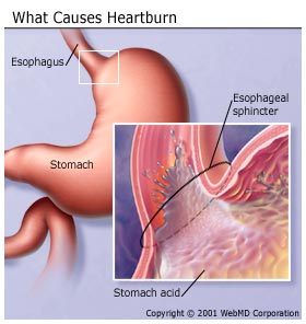 digestive_diseases_heartburn_gastroesophageal_reflux_disease_GERD