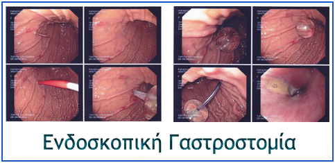 endoskopiki gastrostomia